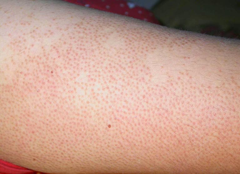 Cách trị viêm lỗ chân lông ở bắp chân