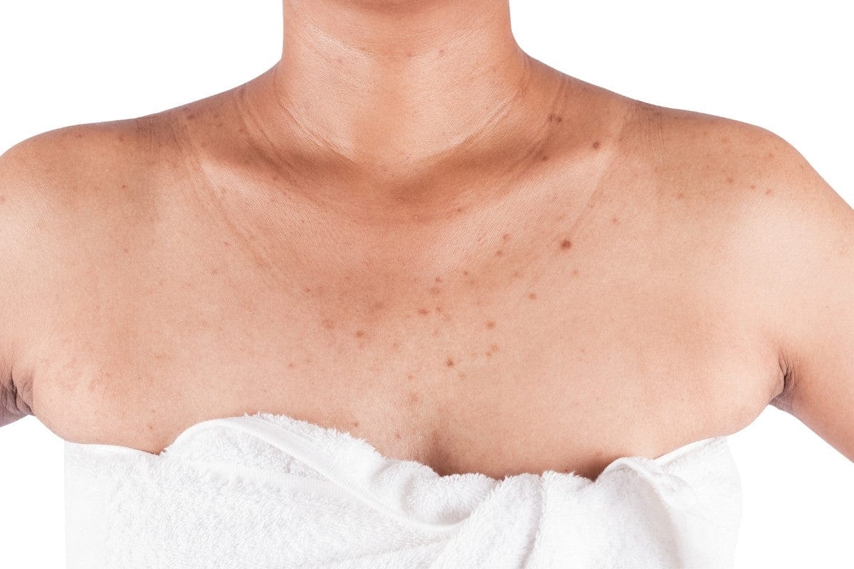 Vì sao da body bị xỉn màu, không đều màu? Nguyên nhân và cách cải thiện