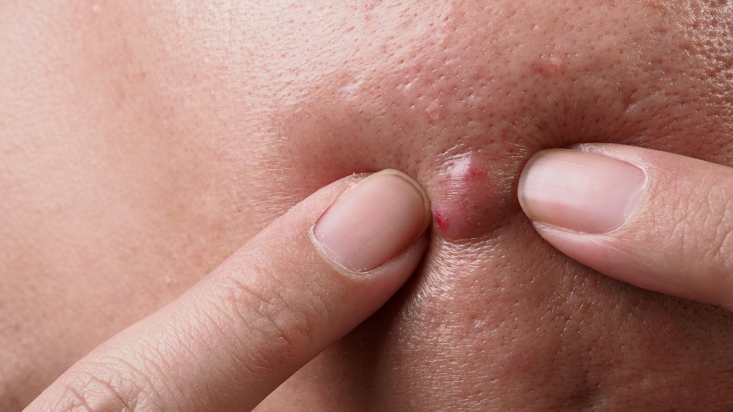 Mụn bọc có nên nặn không