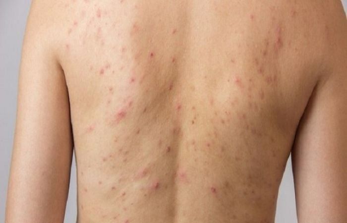 Nam giới bị mụn lưng