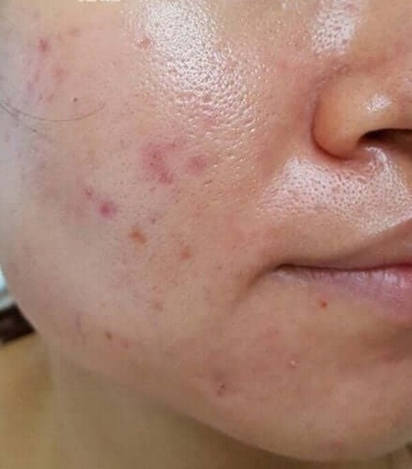 Trị da dầu vĩnh viễn