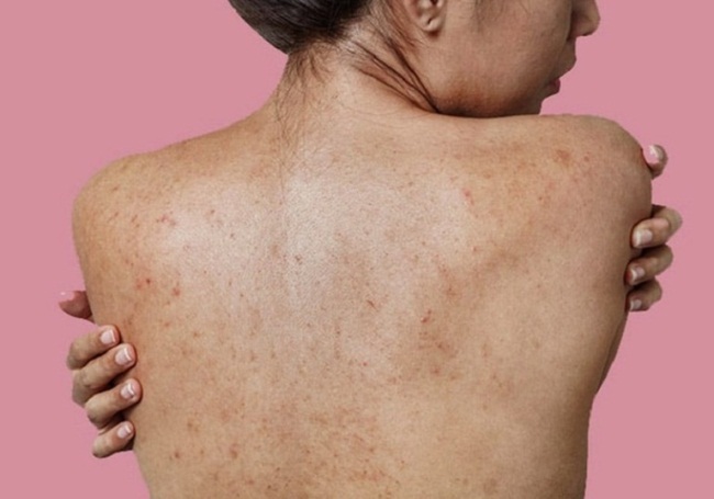 Cách cải thiện da body sần, viêm nang lông hiệu quả và an toàn